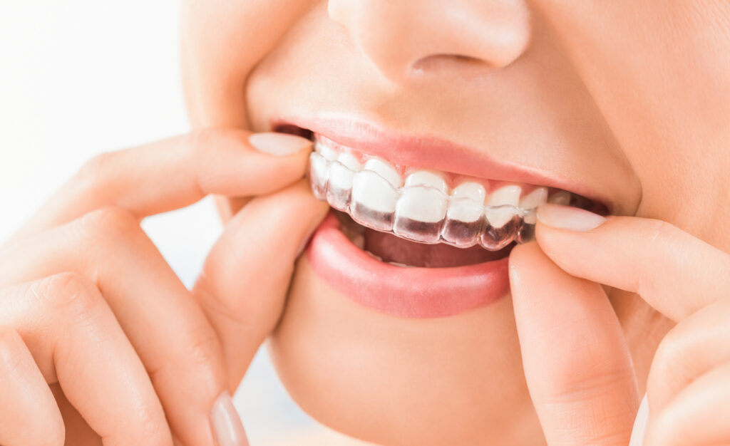 Invisalign in Green Brook, NJ: What to Expect From Clear Aligner Treatment